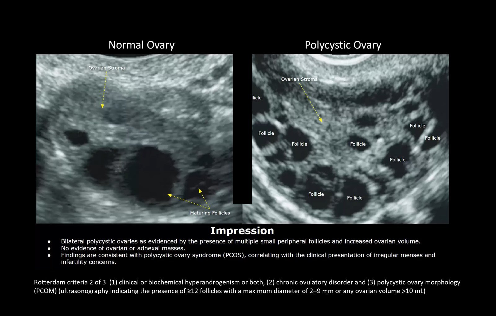 Normal vs polycystic ovary on ultrasound