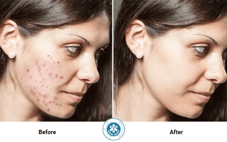 Severe Acne